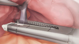 Cutting and Stitching （Endoscopic Staplers）